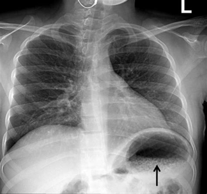 air bubbles in stomach