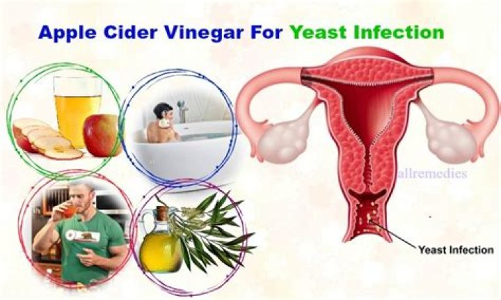 apple cider vinegar bath yeast infection