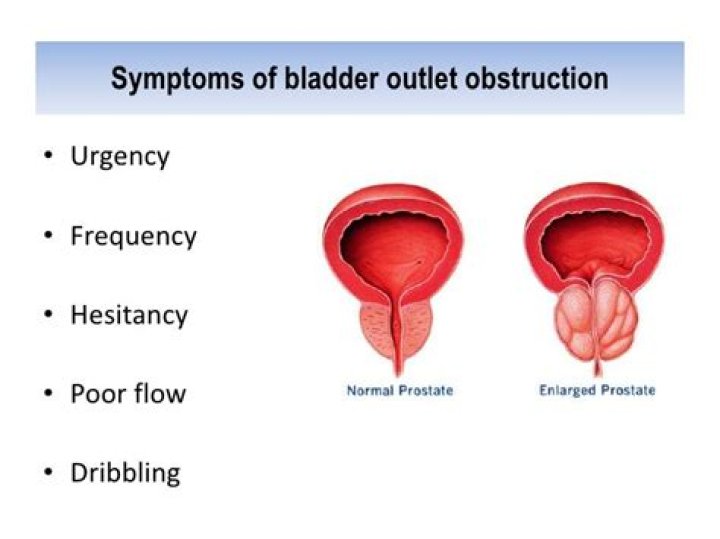 bladder outlet obstruction icd 10
