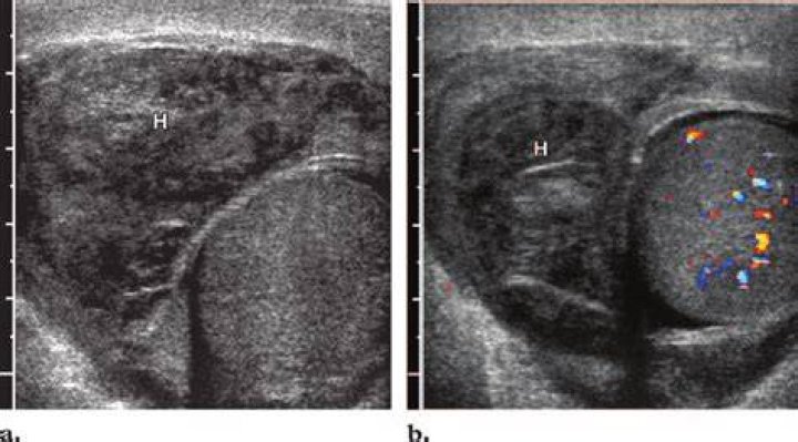 hernia testicular swelling