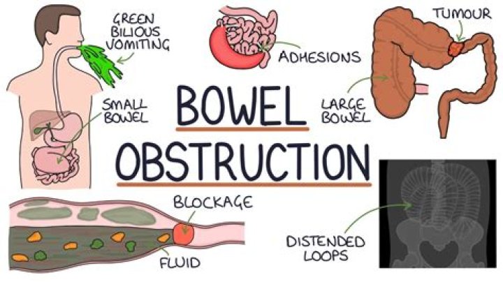 how long can you live with a bowel obstruction