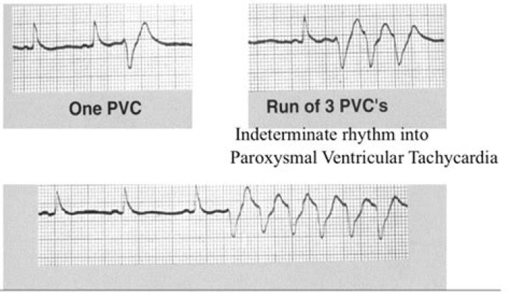 how many pvcs per minute are too many