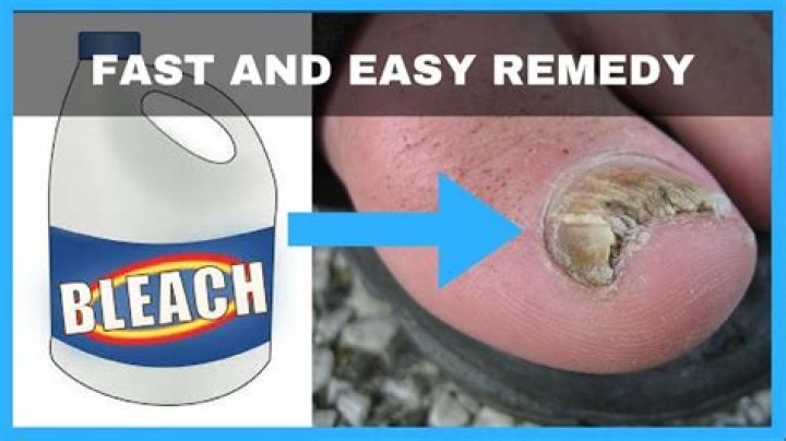how to get rid of toenail fungus with bleach
