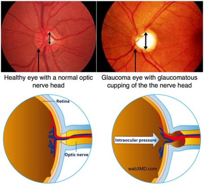 large optic nerve