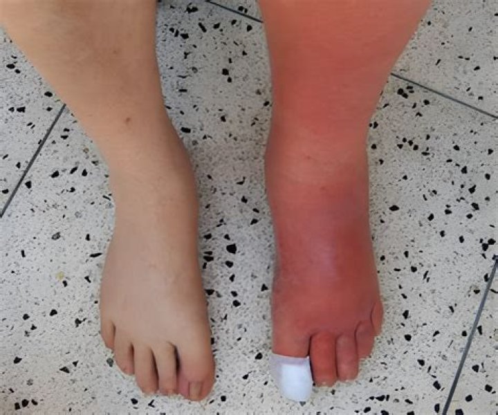 left leg cellulitis icd 10