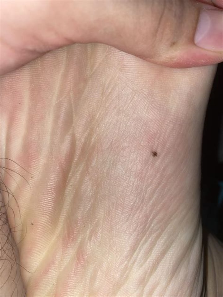 mole on bottom of foot