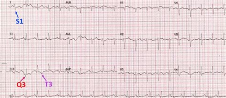 s1q3t3 ecg