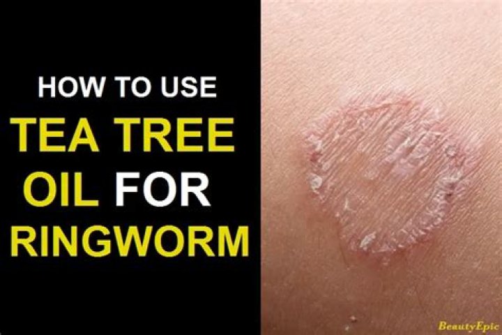 tea tree oil for ringworm