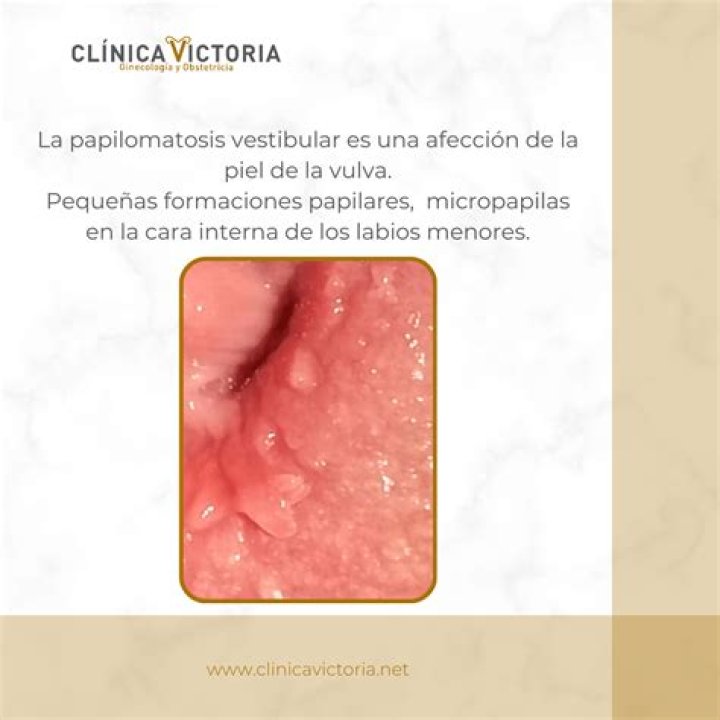 vestibular papillae
