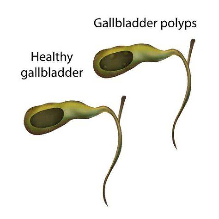 what causes gallbladder polyps