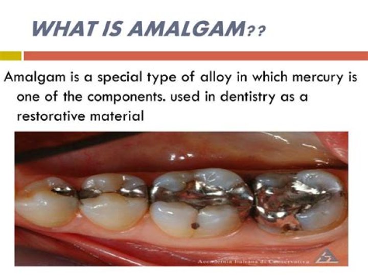 what is amalgam