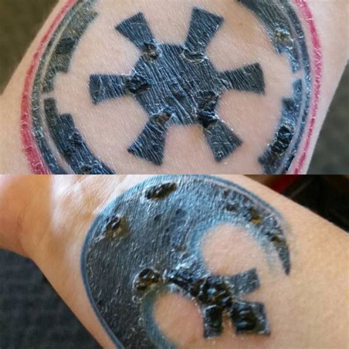 what to do when tattoo is peeling